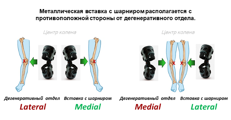 Подбор ортеза Orliman GONARTEC® PLUS